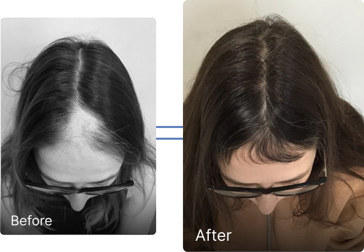 Before and after hair restoration