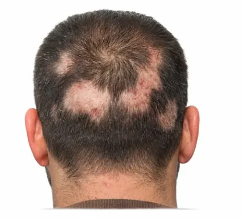 Crown Thinning & Bald Spots